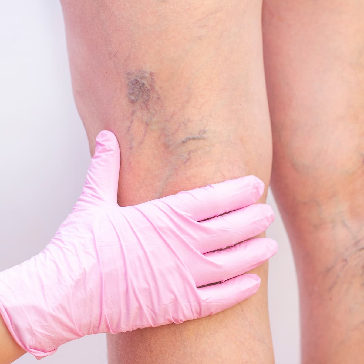 About - Vein Doctor of NJ | Vein Doctor of NJ