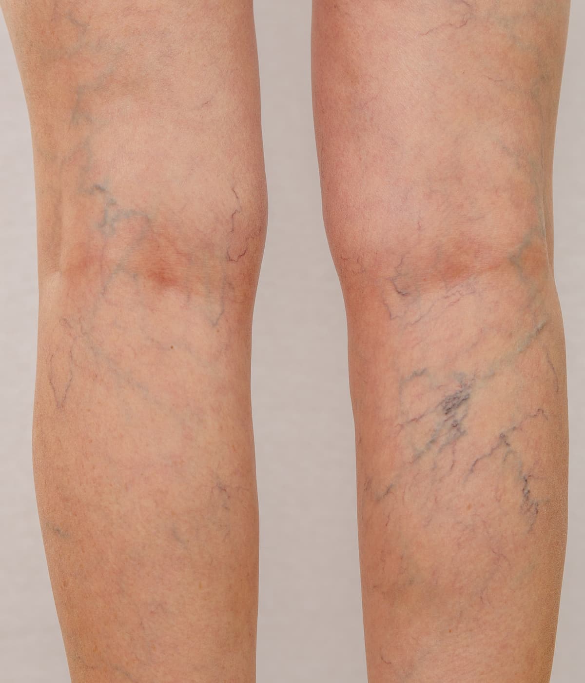 Compression Therapy Benefits | Vein Doctor of NJ