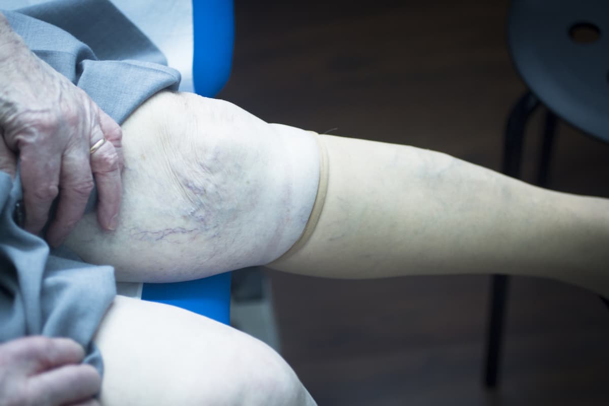 Compression Therapy Benefits | Vein Doctor of NJ