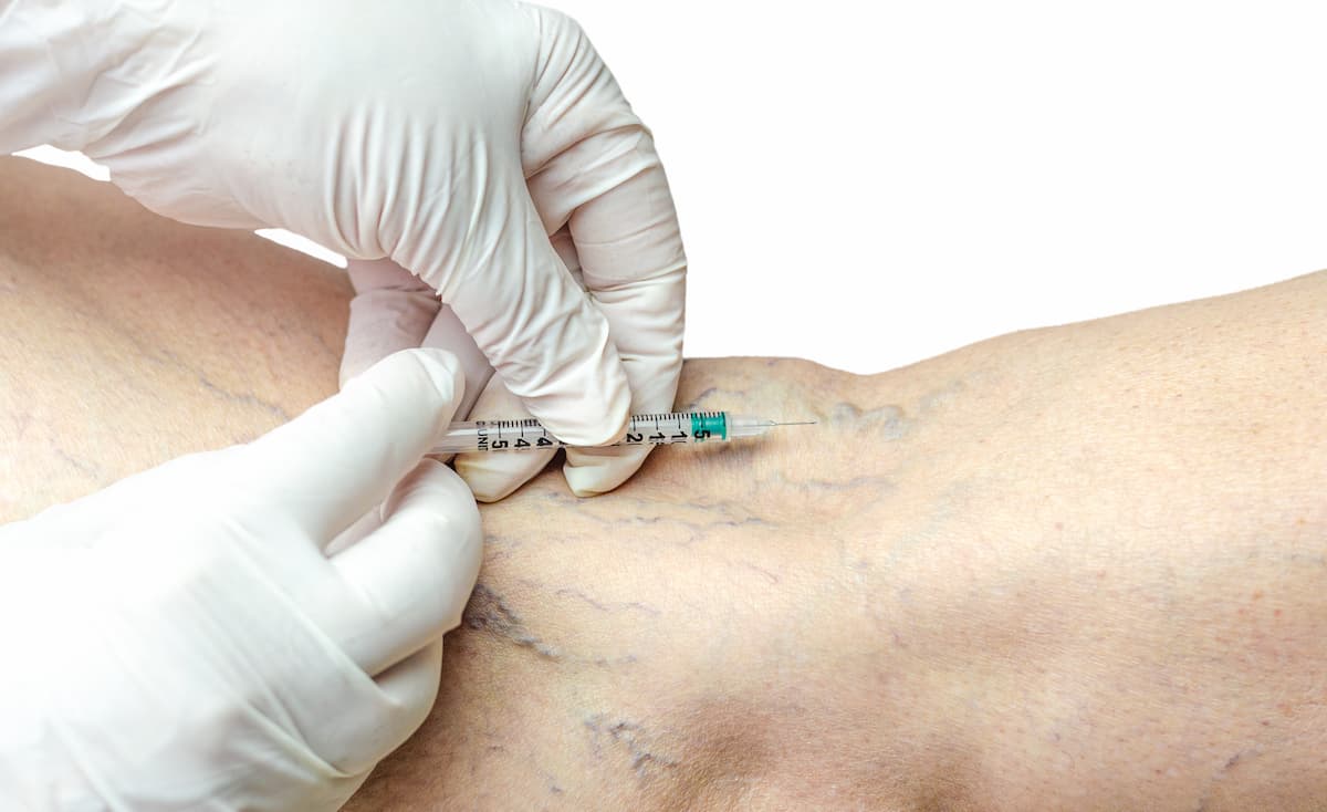 Sclerotherapy for Spider Veins