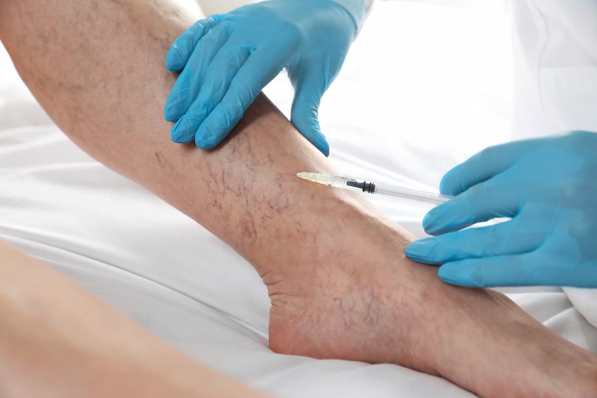 Sclerotherapy for Spider Veins | Vein Doctor of NJ