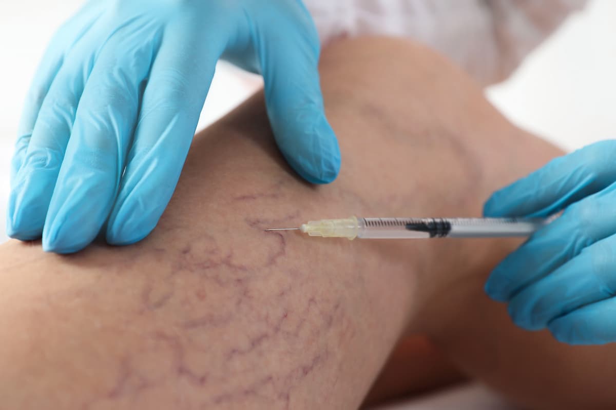 Sclerotherapy for Spider Veins | Vein Doctor of NJ