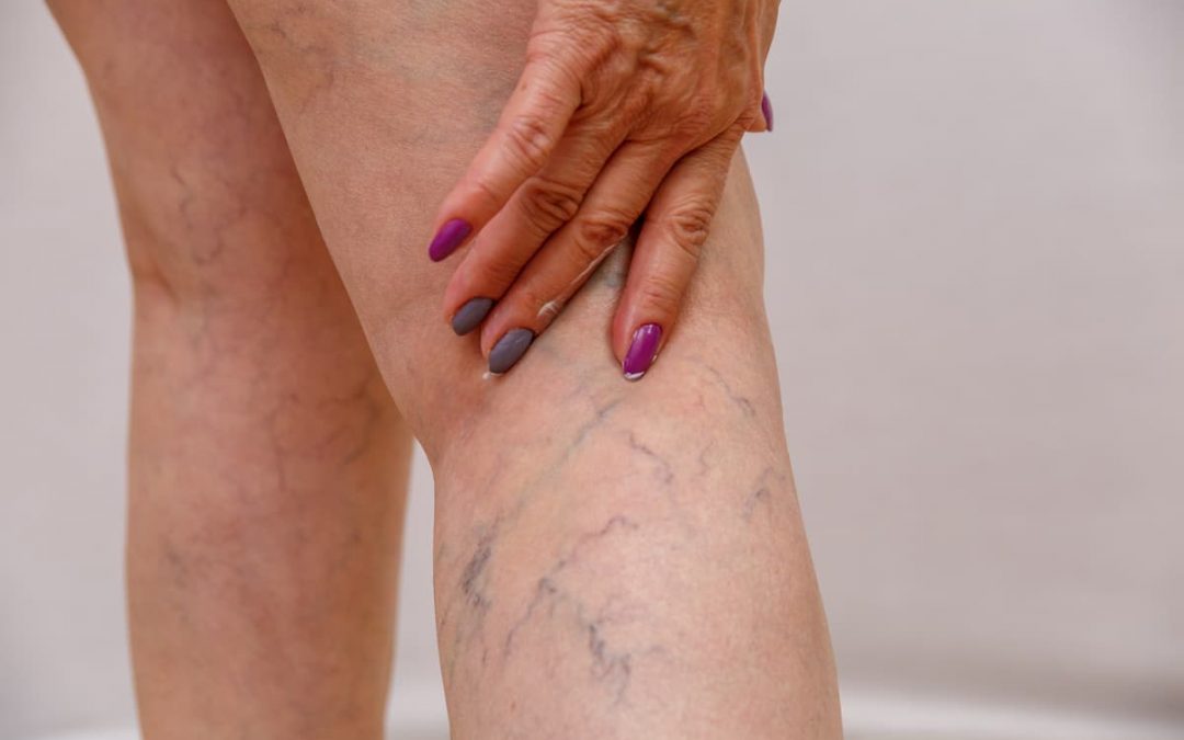 Sclerotherapy for Spider Veins