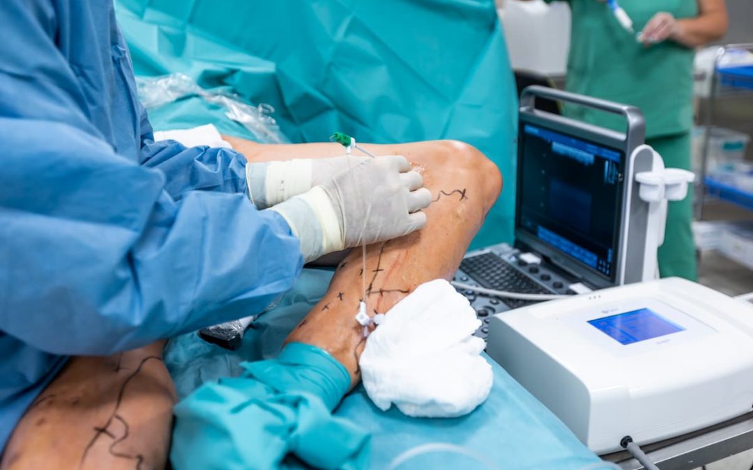 Radiofrequency Ablation (RFA)