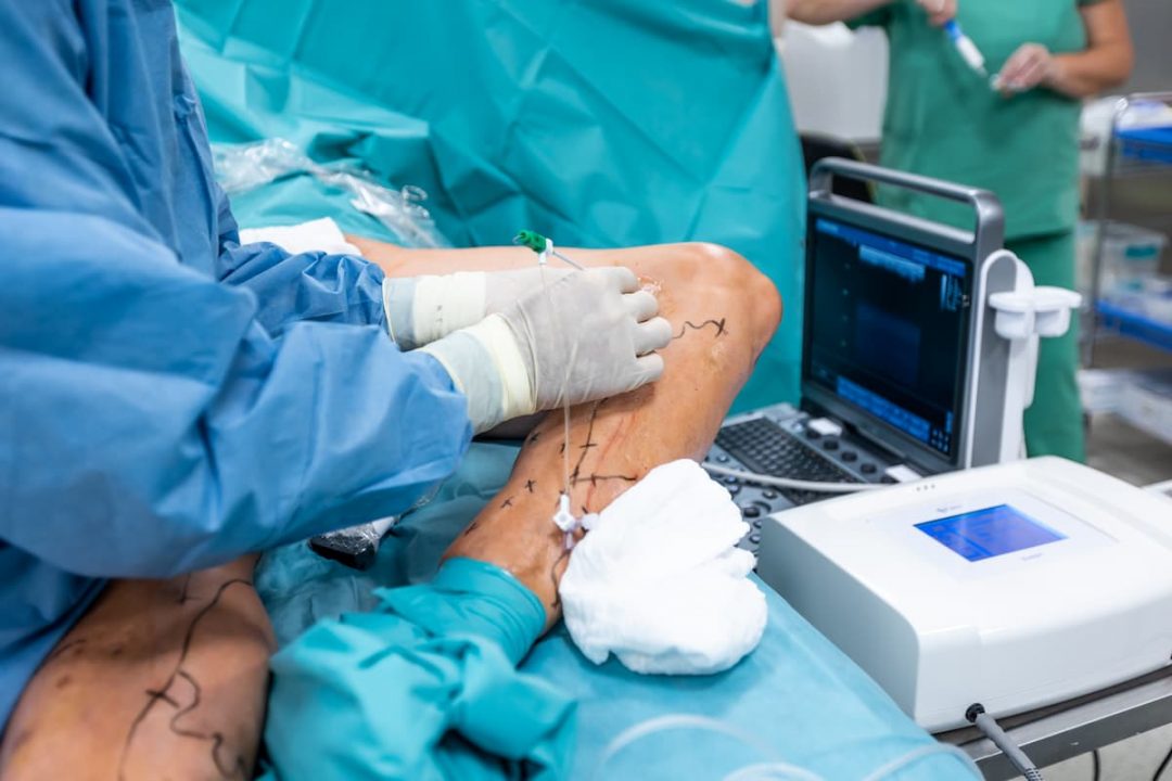 Radiofrequency Ablation (RFA)